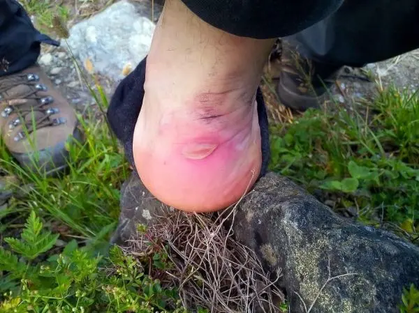 Blasenbildung an der Ferse eines Fußes, umgeben von Gras und Steinen