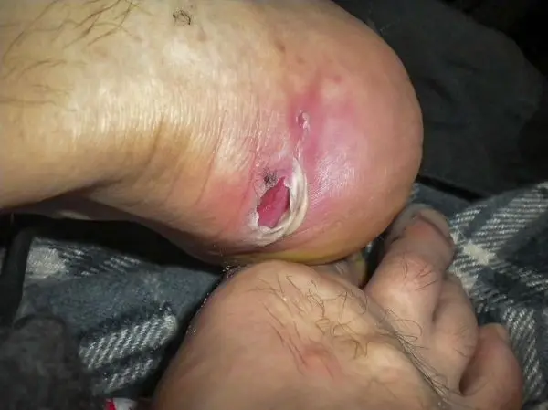 Wunde am Fuß mit Rötung und Blasenbildung, umgeben von Haaren