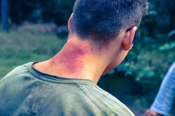 Roter Hautausschlag am Nacken eines Mannes, der einen grünen Shirt trägt