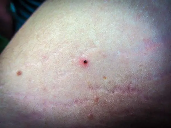 Kleiner schwarzer Punkt auf heller Haut, möglicherweise ein Zeckenbiss