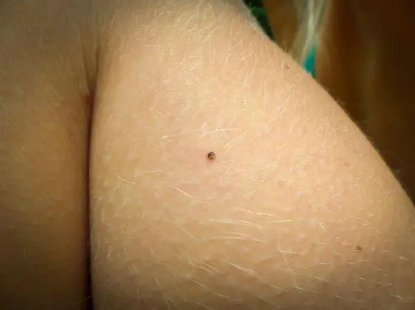 Kleine Zecke sitzt auf der Haut eines Oberarms